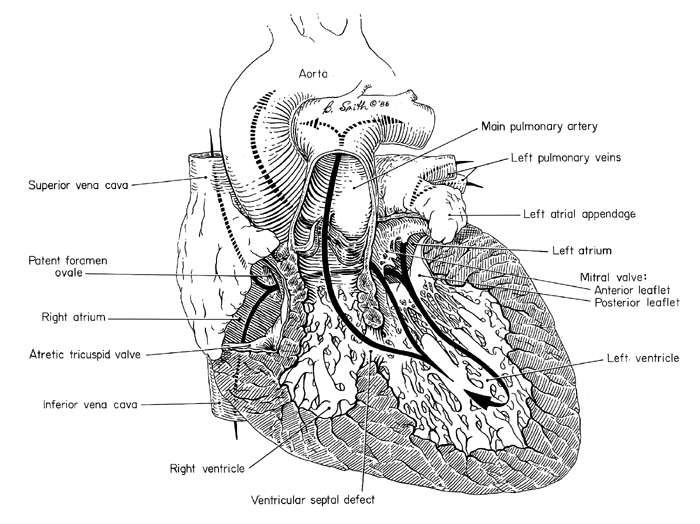 Tricuspid Atresia