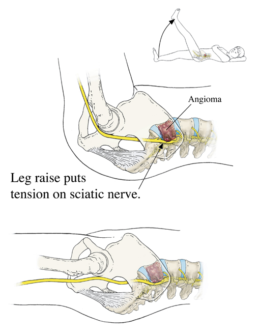 Angioma, Sciatic Strain